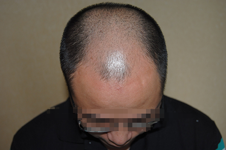 克隆毛囊植发最新动态，美发宝藏藏于小巷的秘密之中
