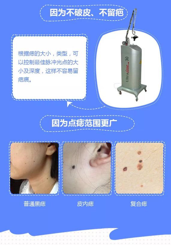 祛痣最新技术，科技与美丽的完美结合